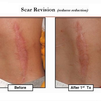 Medlaser - Scar Revision - Laser Hair Removal Near Me - Yonkers, New York Medlaser - Scar Revision - Laser Hair Removal Near Me - Yonkers, New York