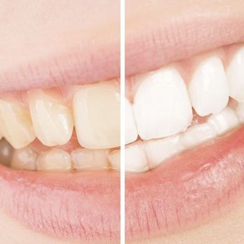 We Whiten Gilbert - Teeth Whitening Near Me - Gilbert, Arizona