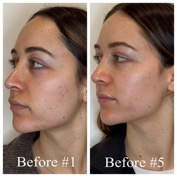 Alchemy Aesthetics - Before and after 5 Aerolase laser treatments - Medical Spas Near Me - Fair Oaks, California