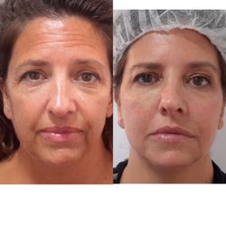 Tribeca Medspa by AYA Skin - Non Surgical Liquid Facelift