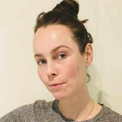 Glowing skin after a superficial peel