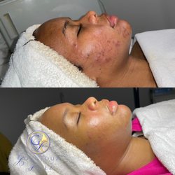 Gorgeouz Facez Spa - Client has acne breakouts, and discoloration. So results within six months of treatment.