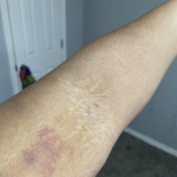 CSL Plasma - They say the only prick you once but this was the bruise and TWO STAB marks from the week prior.