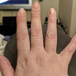 Saturday evening. One and a half days post-visit. 2 nails almost completely chipped off. Saturday evening. One and a half days post-visit. 2 nails almost completely chipped off.