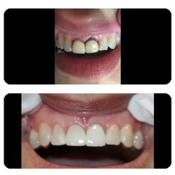 Guillermo J Rubiano, DDS - Old crowns and composites. Replaced with new crowns and composites.