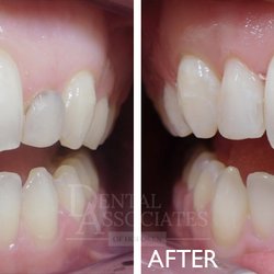 Dental Associates of Hoboken - Gum Contouring
