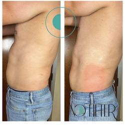 No Filter Brazilian Med Spa - Fat freezing