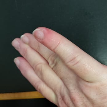 AK Nails & Spa - Swollen,pus filled finger - Nail Salons Near Me - Concord, California AK Nails & Spa - Swollen,pus filled finger - Nail Salons Near Me - Concord, California