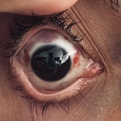 The LASIK Vision Institute - Messed up eye