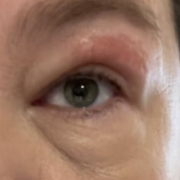 The day after my wax. Eye is swollen and skin was basically burned off. Cheap wax! The day after my wax. Eye is swollen and skin was basically burned off. Cheap wax!