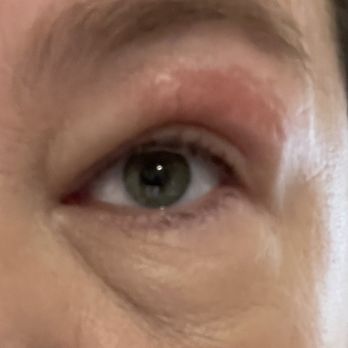 Grand Nails & Spa - The day after my wax. Eye is swollen and skin was basically burned off. Cheap wax! - Nail Salons Near Me - Lodi, California Grand Nails & Spa - The day after my wax. Eye is swollen and skin was basically burned off. Cheap wax! - Nail Salons Near Me - Lodi, California