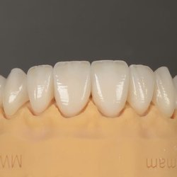 M.I. Dental Designs - Veneers