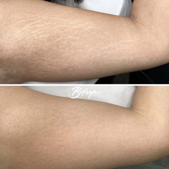 Boleyn studio - these are my stretch marks before and then 3/4 months after treatment ! - Permanent Makeup Near Me - Beverly Hills, California