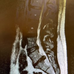Klein Chiropractic - Lumbar herniation