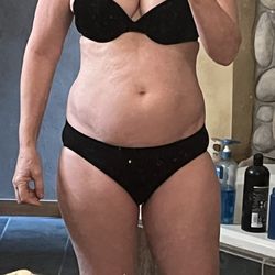 Wright Surgical Arts - After lipo, post op. Obviously not skin!