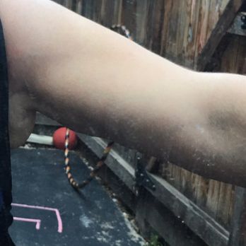 Purely You - Here's my right arm where 550 ccs were taken out vs the left only 500ccs. Yet, Dr. Z said he didn't know why he did that! - Weight Loss Centers Near Me - Aurora, Colorado