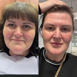 Farkas Plastic Surgery and Medical Spa - Chin lipo, botox, lips done