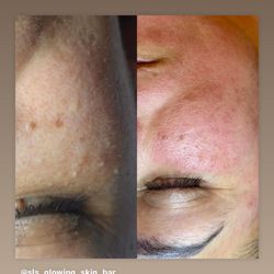 Sls Glowing Skin Bar - Milia Removal
