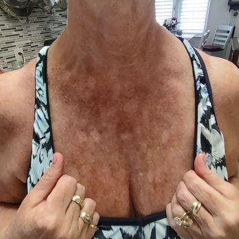 Body Beautiful - Chest 2 months post IPL - Medical Spas Near Me - Cranberry Twp, Pennsylvania Body Beautiful - Chest 2 months post IPL - Medical Spas Near Me - Cranberry Twp, Pennsylvania