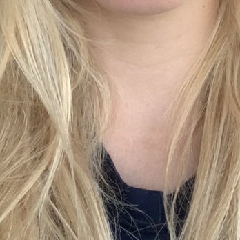 Essential Bella - 2 days after, super swollen, lumpy and uneven - Skin Care Near Me - Pleasanton, California Essential Bella - 2 days after, super swollen, lumpy and uneven - Skin Care Near Me - Pleasanton, California