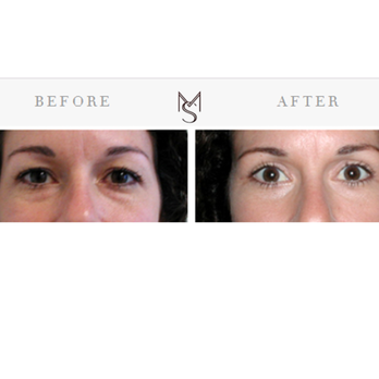 Mossi Salibian, MD - Upper & Lower Eyelid Surgery (Quad Blepharoplasty) - Cosmetic Surgeons Near Me - West Hollywood, California Mossi Salibian, MD - Upper & Lower Eyelid Surgery (Quad Blepharoplasty) - Cosmetic Surgeons Near Me - West Hollywood, California