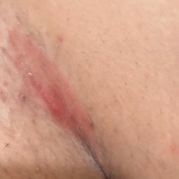 this is only ONE of the burns.. this is only ONE of the burns..