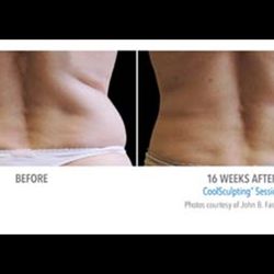 IOIO Studio - CoolSculpting