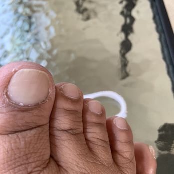 2NE1 Nails - this is my toe with dry skin still attached after $35 spa pedicure - Reflexology Near Me - Williamsville, New York