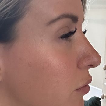 Sole Med Spa - Mobile - 2 days before microneedling. This makes me want to cry. Tighter, bouncier skin. No pit marks. Just some visible pores in the T-zone. - Skin Care Near Me - Mobile, Alabama Sole Med Spa - Mobile - 2 days before microneedling. This makes me want to cry. Tighter, bouncier skin. No pit marks. Just some visible pores in the T-zone. - Skin Care Near Me - Mobile, Alabama