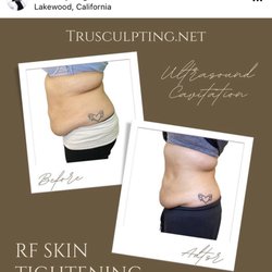 Tru Sculpting Health & Beauty - Ultrasound Cavitation/ RF Skin Tightening