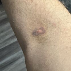Quest Diagnostics - 2days later still sore