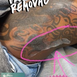 Laser Tattoo Removal (PFD Patches)
