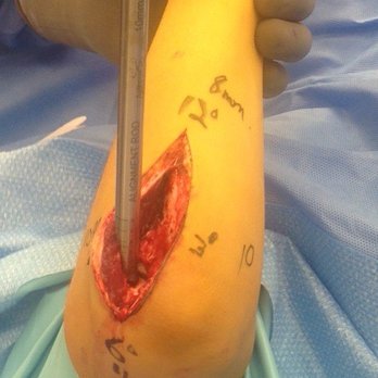 Bellevue Hand Surgery - During Osteochondral Allograft Transplantation surgery on my right elbow - Orthopedists Near Me - Bellevue, Washington