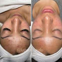Lush Skin Studio - Six weeks progress on our acne program!