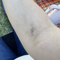 Labcorp - Second bruising on the other arm.