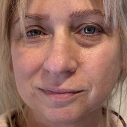 Radiance Medspa San Antonio - Before