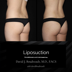 Liposuction in Palo Alto by board certified plastic surgeon, Dr. David Boudreault