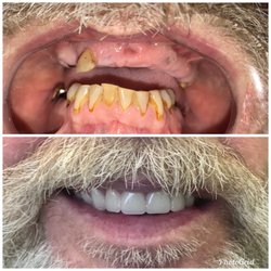 Modern Dental and Implants - Full mouth extraction with new upper denture