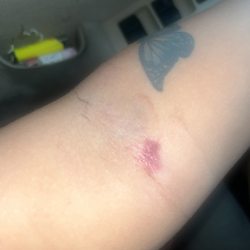 Memorial Emergency Center - Bruising from where she ripped out Iv