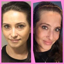 Face Time With Carolyne - Tear trough filler under my eyes, cheek filler to lift, nasal folds filled. Botox done&my lips have been plumped up with filler.