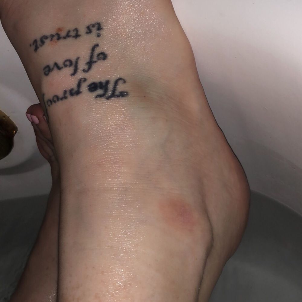 Century Nails & Spa - Bruising still on the outside and still swollen weeks later! - Nail Salons Near Me - Tacoma, Washington