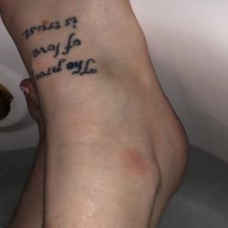 Bruising still on the outside and still swollen weeks later!