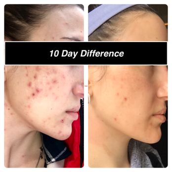About Face Aesthetics - Before & After seeing Briana for my emergency outbreak! Only a 10 DAY difference!!! - Skin Care Near Me - Philadelphia, Pennsylvania About Face Aesthetics - Before & After seeing Briana for my emergency outbreak! Only a 10 DAY difference!!! - Skin Care Near Me - Philadelphia, Pennsylvania