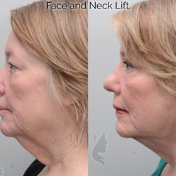 Nuance Facial Plastics - The face and neck lift can provide striking results, contouring the neck line while taking years off of the apparent age of the face.