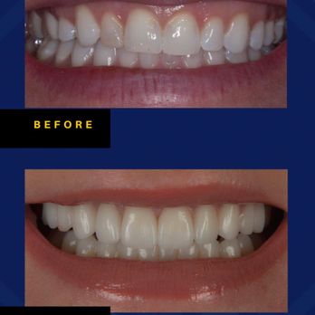 Steven Abel, DMD - Porcelain Veneers fixed worn, and chipped teeth for Jenny. - General Dentistry Near Me