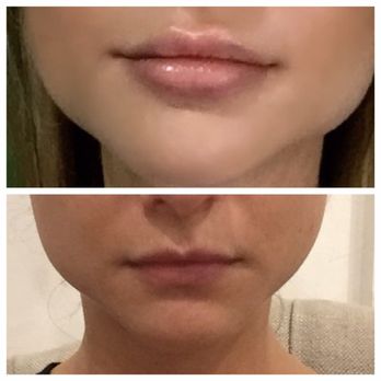 Leslie Gerstman, MD - After 24 hours. First timer, 1 syringe - Skin Care Near Me - New York, New York Leslie Gerstman, MD - After 24 hours. First timer, 1 syringe - Skin Care Near Me - New York, New York