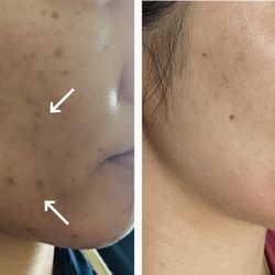 Oakland Hills Acupuncture & Integrative Medicine - Before/ After 3 Microneedling Sessions