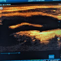 Amw Concierge Imaging - Carotid artery screening is used to detect plaque buildup, which can increase the risk of stroke.