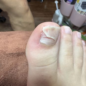 Organic Nails Studio - My toe nails before from soccer impact trauma. Both nails fell off from getting stepped on with cleats - Nail Salons Near Me - Kirklin, Indiana