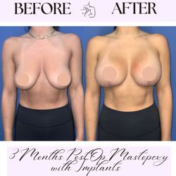 Michelle Cabret, MD DDS - Mastopexy with implants by Dr. Michelle Cabret at The Cosmetic Center in Scottsdale AZ